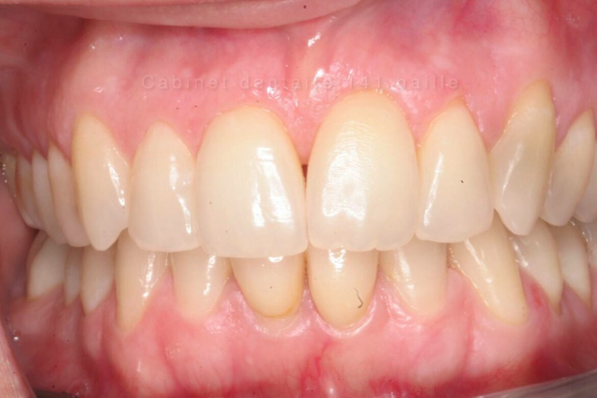 Comment faire une gouttière de blanchiment ?