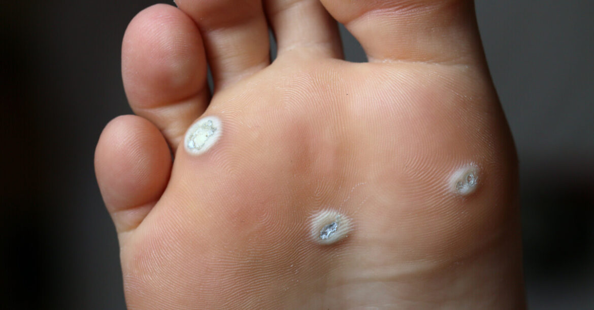 Comment de débarrasser des verrues séborrhéiques ?