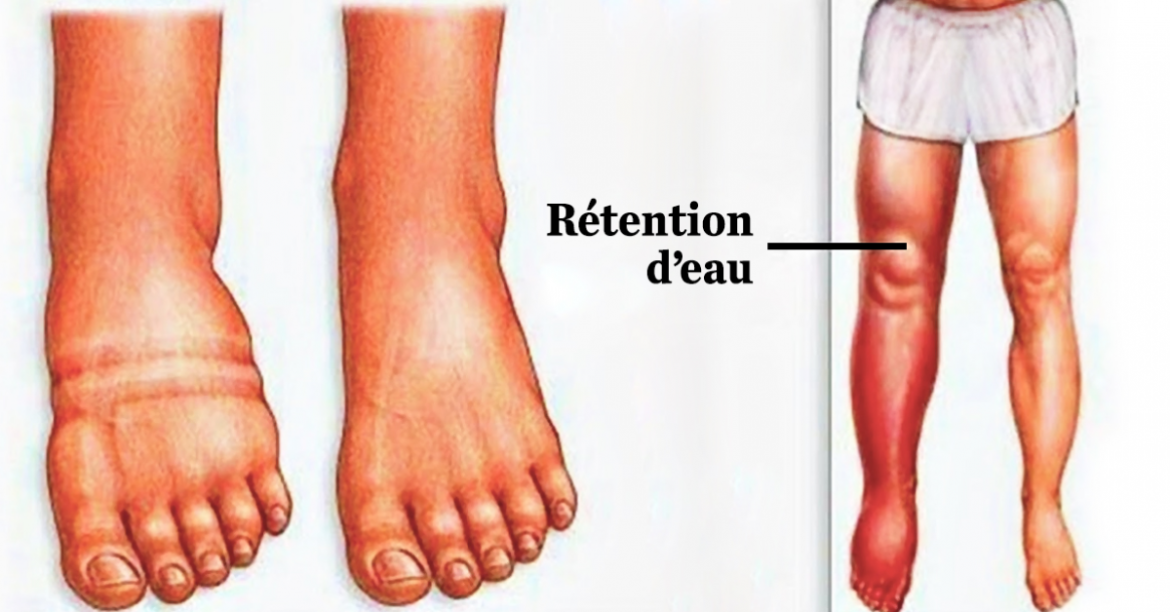 Comment diminuer l'œdème du pied ?
