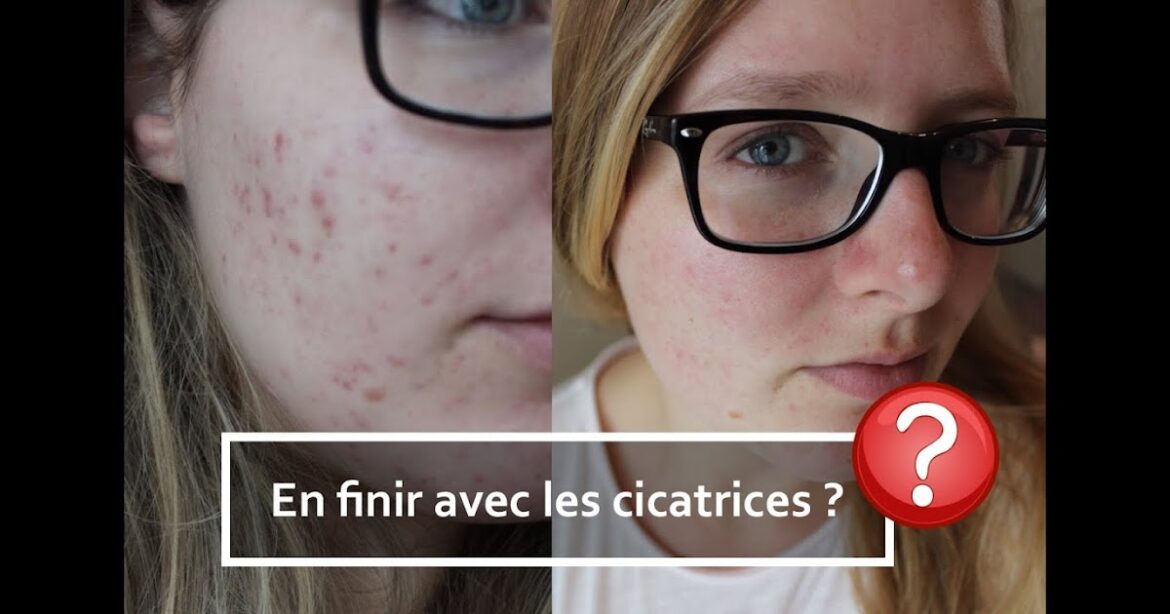 Comment faire partir les tâche d'acné ?