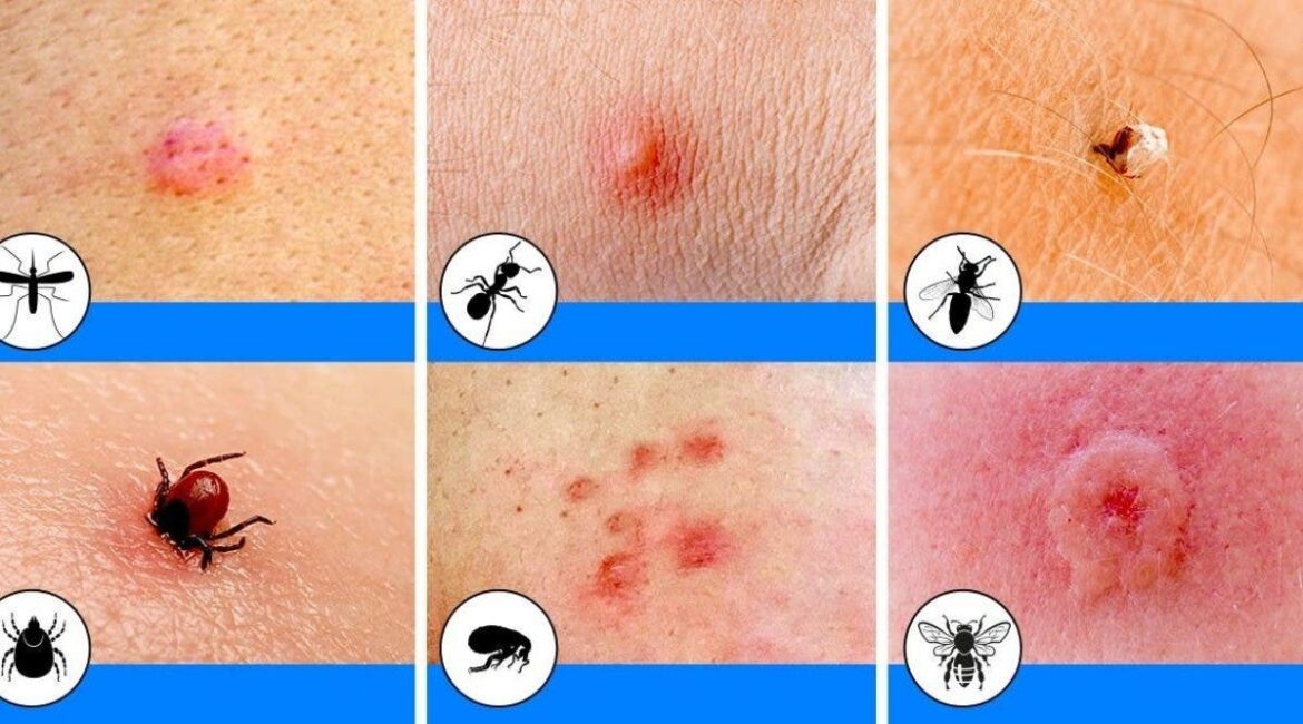 Comment reconnaître les piqûres d'araignée ?