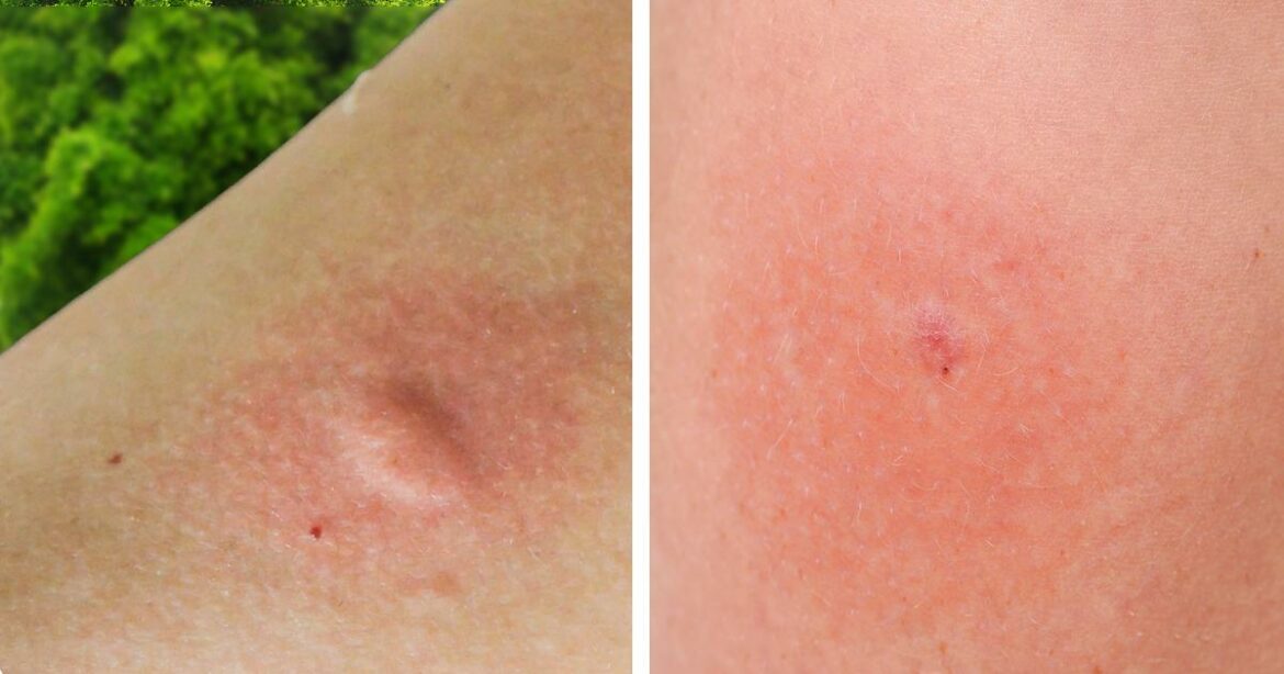 Comment reconnaître l'insecte qui nous a piqué ?