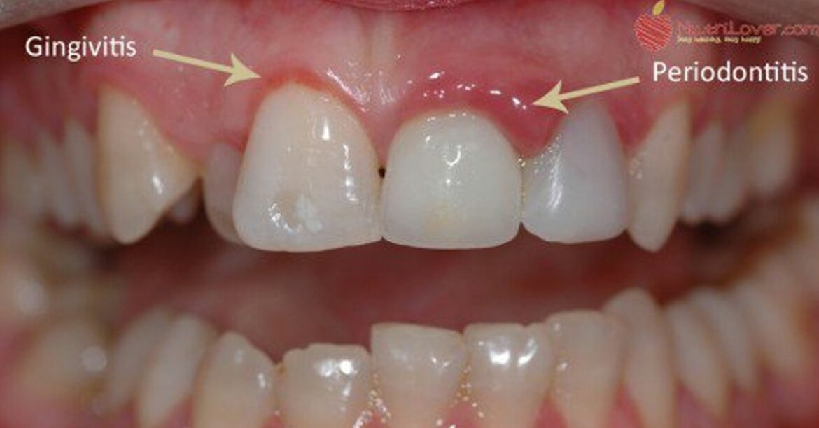 Comment soigner le pancréas naturellement ?