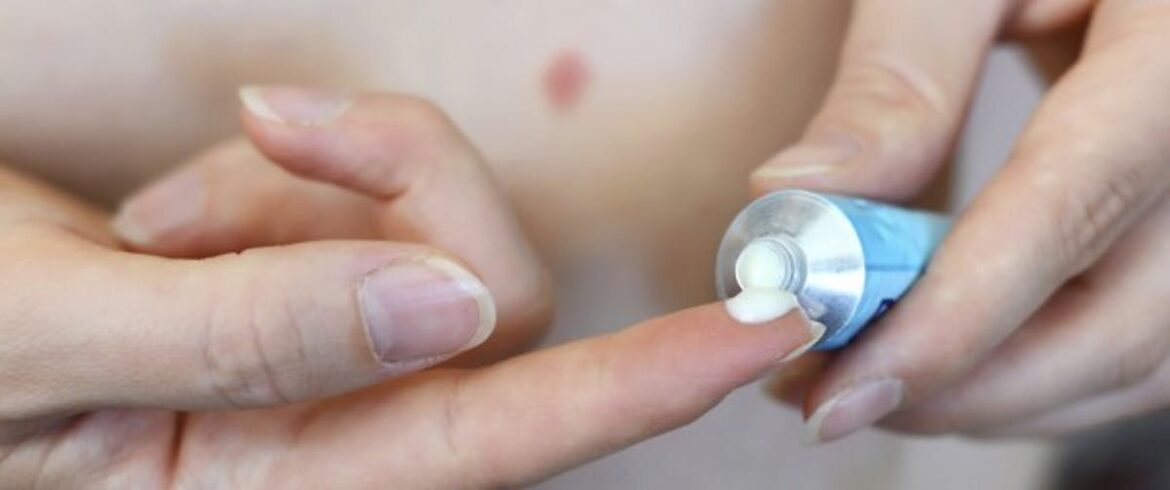 Comment soigner une piqûre d'insecte infectée ?