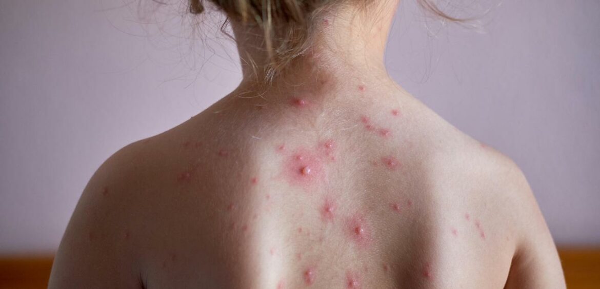 Comment traiter un fusain maladie ?